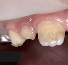 Zuby dítěte před ošetřením v Dynasty Stomatology — případ 1