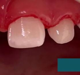 Zuby dítěte po ošetření v Dynasty Stomatology — případ 3