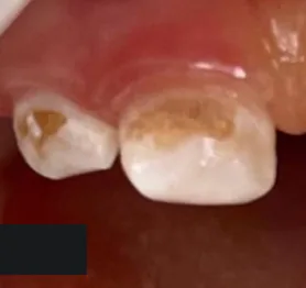 Zuby dítěte před ošetřením v Dynasty Stomatology — případ 3