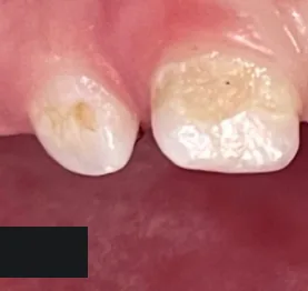 Zuby dítěte před ošetřením v Dynasty Stomatology — případ 4